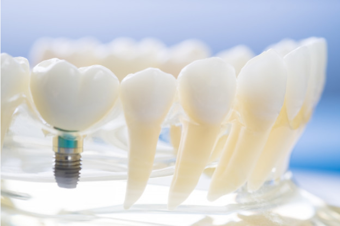 También existe otro tipo de prótesis fija que se le conoce como prótesis híbrida sobre implantes. La estructura de esta prótesis va atornillada sobre los implantes de dientes, la misión de esta es la de reponer las piezas faltantes y encías perdidas. En pocas palabras es como si fuera una caja de dientes sin paladar que va fijada con los tornillos, pero aporta una mejor estética, firmeza y comodidad. Se asemeja bastante a los dientes propios.