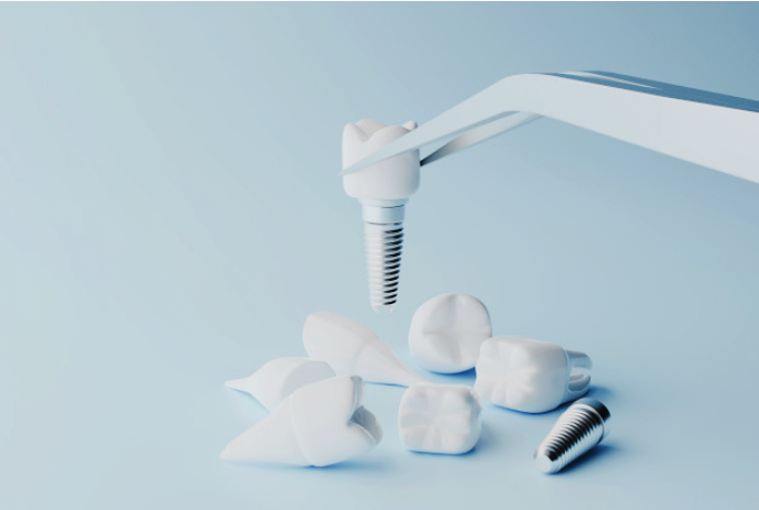 La implantación dental es una excelente alternativa para la reposición de dientes perdidos o “ausentes”. En pocas palabras son como raíces dentales pero artificiales. La gran mayoría están hechos de titanio puro que es un material biocompatible que se une al hueso física y químicamente en un proceso conocido como osteointegración.
