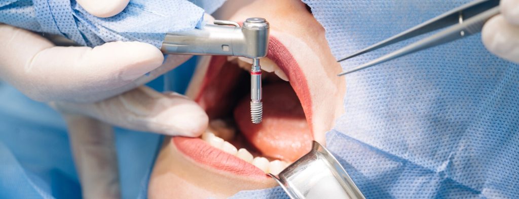 02-cirugia-implantes-carousel